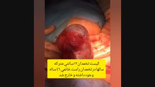 فیلم جراحی کیست تخمدان