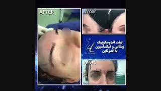 لیفت اندوسکوپی پیشانی و فیکساسیون با اندوتاین