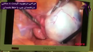 جراحی لاپاراسکوپی درمویید بزرگ ۸ سانتی با حفظ تخمدان ها