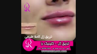 فیلم تزریق ژل | کلینیک رز | 09104440228 | شماره 175