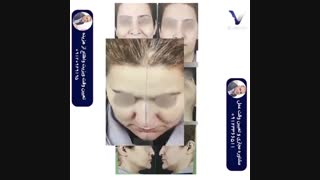 جراحی بینی با قوز و انحراف شدید بلافاصله بعد از عمل