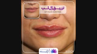 تزریق ژل لب در کلینیک ارکیده