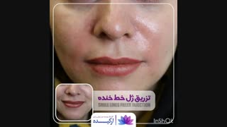 تزریق ژل خط خنده در کلینیک ارکیده