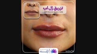تزریق ژل لب در کلینیک ارکیده
