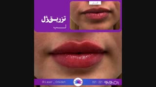 تزریق ژل لب در کلینیک ارکیده