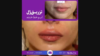 تزریق ژل لب و خط خنده  در کلینیک ارکیده