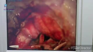 علت درد پشت گردن و بی حسی دست ها