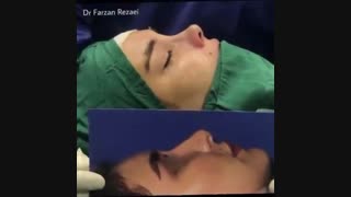جراحی بینی بعد از یکسال