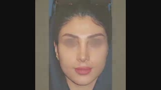 جراحی بینی گوشتی به صورت طبیعی
