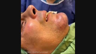 جراحی بینی همزمان با تزریق چربی