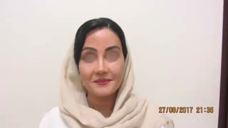 لیفت پیشانی لیپوماتیک