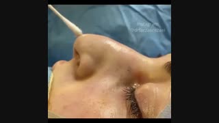 فیلم بدون سانسور جراحی بینی نیمه فانتزی