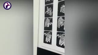 جراحی شکستگی دررفتگی شانه