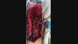 درمان اسکولیوزیس دژنراتیو و تنگی کانال کمری