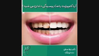 کامپوزیت ونیر باعث پوسیدگی دندان ها نمی شود.