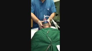 بوژیناژ تنگی راه هوایی در بیمار اپنه