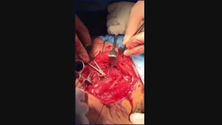 سرطان وسیع حلق و مری گردنی که خارج شد و بازسازی مری با پوست بازو