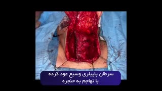 سرطان پاپیلری وسیع عود کرده با تهاجم به حنجره