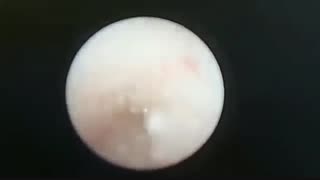 سنگ شکنی درون اندامی