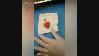 جراحی توده فیبروآدنوم