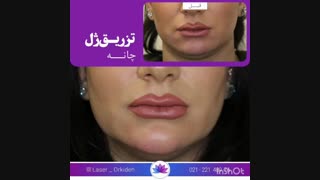 تزریق ژل چانه در کلینیک ارکیده