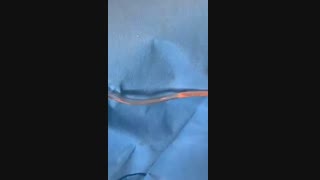 فیلم لحظه لیپوماتیک شکم و پهلو به همراه ابدومینوپلاستی