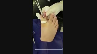 التهاب کنار ناخن کامپوزیت ونیر