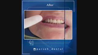 کامپوزیت ونیر