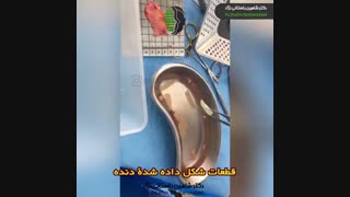 مواد مورد استفاده در جراحی ترمیمی بینی | دکتر باستانی نژاد