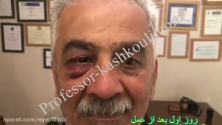 فیلم جراحی تومور حدقه بدون برش و بخیه پوستی | پروفسور کشکولی