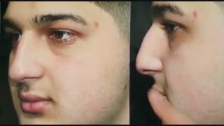 جراحی بینی استخوانی و برطرف کردن قوز بینی توسط دکتر امید ابراهیمی بهترین جراح بینی
