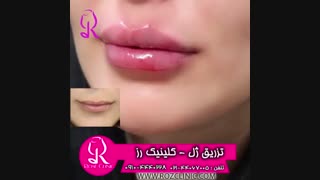 فیلم تزریق ژل | کلینیک رز | 09104440228 | شماره 182