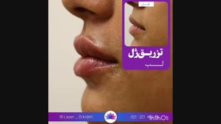 تزریق ژل لب در کلینیک ارکیده