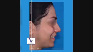 جراحی بینی با پوست ضخیم