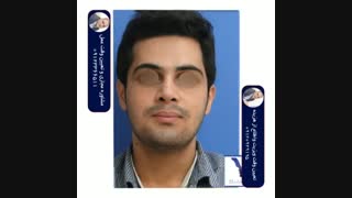 جراحی بینی مردانه با پوست ضخیم و قوز و انحراف شدید