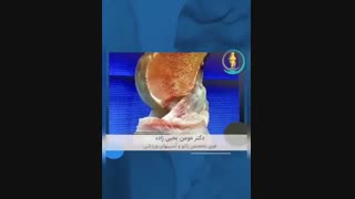 چگونگی عملکرد رباط صلیبی قدامی