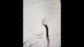 آنژیوپلاستی و استنت گذاری تنگی شدید شریان کاروتید داخلی