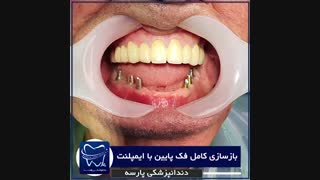 ایمپلنت دندان