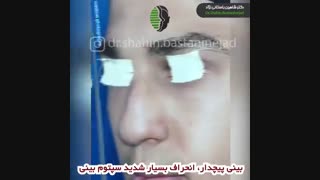 جراحی بینی پیچدار با انحراف شدید تیغه بینی | دکتر باستانی نژاد