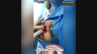 فیلم جراحی زیبایی بینی در بیمار مبتلا به شکاف بینی | دکتر باستانی نژاد