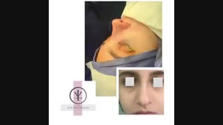 فیلم عمل انحراف بینی