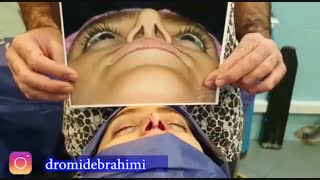 عمل ترمیم بینی با استفاده از غضروف لاله گوش توسط دکتر امید ابراهیمی بهترن جراح بینی