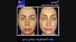 فیلم لیفت آندوسکوپیک پیشانی و ابرو