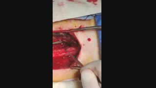 جراحی تومور شوانوم گردن در دختر جوان