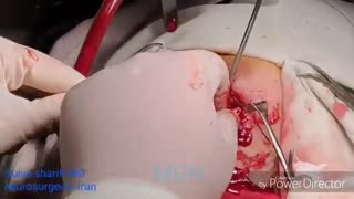 فیلم جراحی درمان آبسه چشم