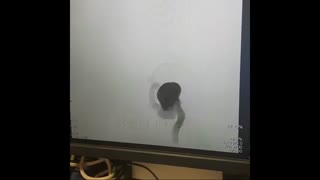 کویل گذاری آنوریسم بزرگ شریان کاروتید داخلی