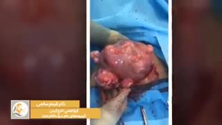 درمان فیبروم های رحمی یا جراحی لاپاراتومی