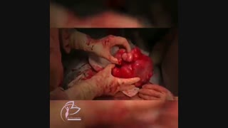 میومکتومی حین سزارین توسط دکتر فروغی فر درمان جای جوش