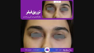 تزریق فیلر زیرچشم  در کلینیک ارکیده