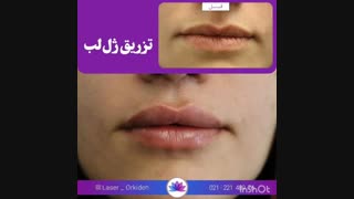 تزریق ژل لب در کلینیک ارکیده